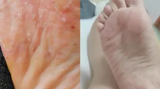 脚底长了像水泡一样的东西很痒是什么原因（脚底长了像水泡一样的东西很痒是什么原因）